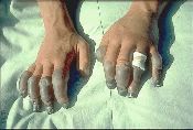 frostbitten hands frostbitten hands